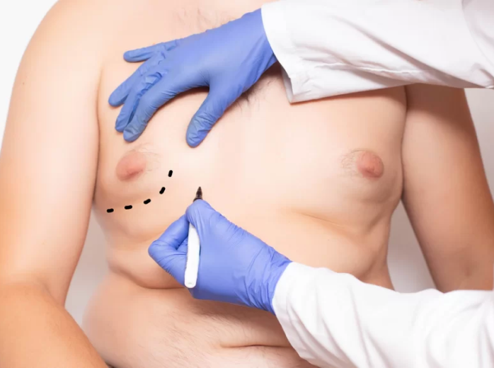 Gynecomastia Surgery